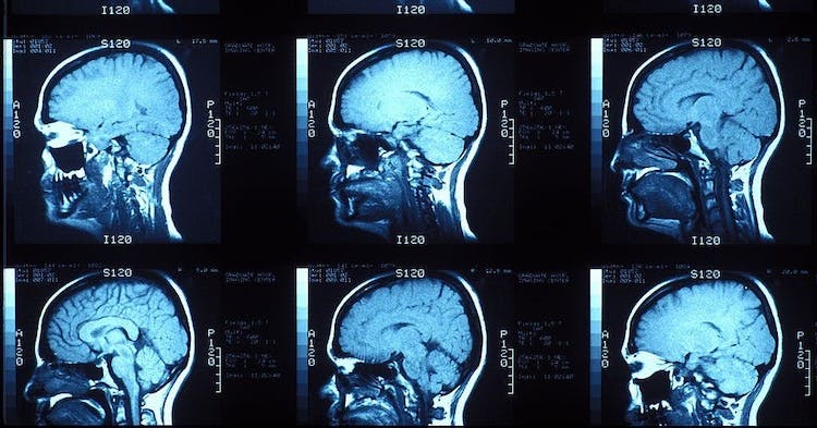 AI 連讀心術都會了？新研究：AI 可將腦部掃描影像翻譯成受試者想法